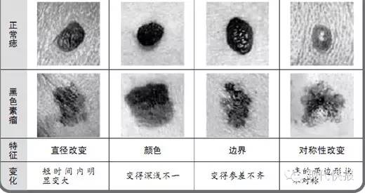 女子腳上黑痣成了惡性瘤,，只因常做這件事……身上有痣的要看！